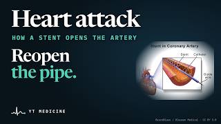 How a Heart Attack Is Treated, and What Lowers the Risk