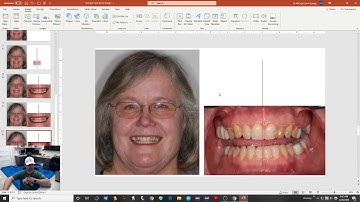 PowerPoint - Smile Design Part 3 - Completing the Smile Design
