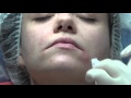«Улыбка Мона Лизы» — подъем опущенных уголков рта за 1 процедуру
