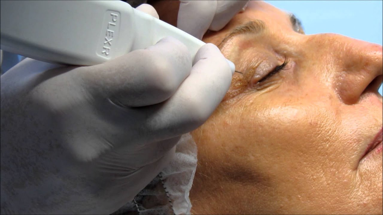 Non surgical Blepharoplasty YouTube