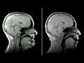 Ultrarapid anatomical mri processing speaking  singing