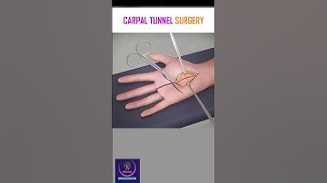 Carpal Tunnel Surgery #shorts