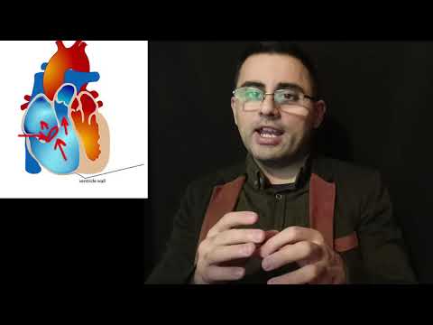 ტრიკუსპიდური სარქვლის რეგურგიტაცია -  ტრიკუსპიდური სარქვლის უკმარისობა