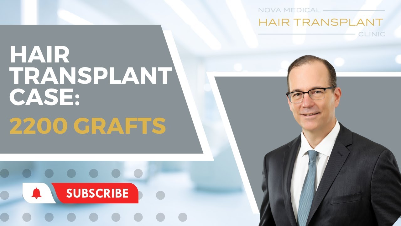 Patient Case with Dr. Gartner 2200 FUE Grafts Nova Medical Hair