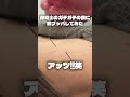 ガチガチ首こりに鍼で一撃! #整体 #鍼治療 #鍼