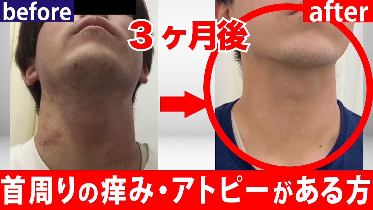 Dramatic improvement] Eliminates atopic dermatitis, rough skin