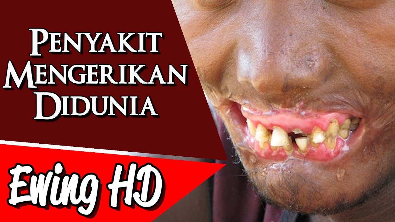 gameplay no commentary apex 5 Penyakit Mengerikan Didunia | #MalamJumat - Eps. 59