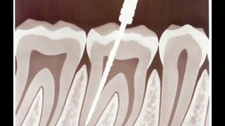 Recomendaciones y complicaciones tras una endodoncia