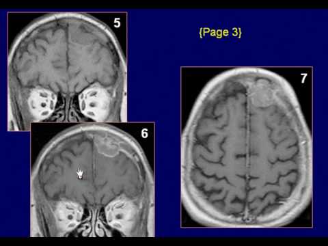 Neuroradiology Case 39