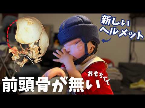 【頭蓋骨欠損】ヘルメット変えたら良い感じです〜！【2歳4ヶ月】