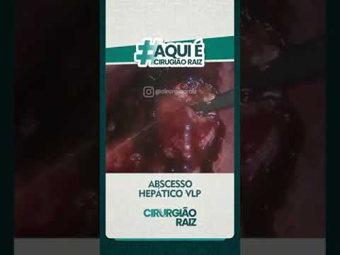 RETIRADA CIRÚRGICA DE ABSCESSO HEPÁTICO