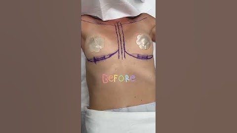 Breast Augmentation I Performed This Morning! #shorts #breastimplants