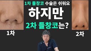 들창코 수술 1차는 쉬워요 그런데 2차 들창코는 실패 확률이 높은 수술이에요