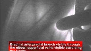 Brachial Artery/Radial Branch One