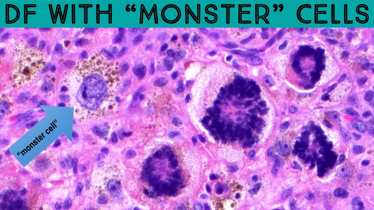 Dermatofibroma with "monster cells" (scary name, benign tumor) dermpath
