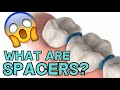 ORTHODONTIC SPACERS: WHAT ARE THEY AND WHY DO YOU NEED THEM?