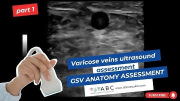 Part 1: Varicose veins ultrasound assessment: GSV anatomy assessment