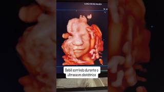 #ultrassom #morfologico #3dfetal #ultrasound #prenatalfitness