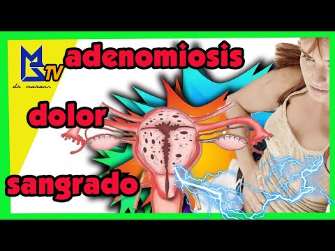 Vídeo: Adenomiosis: Tratamiento De La Adenomiosis Uterina Con Remedios Y Métodos Caseros