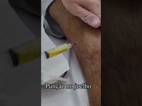 Vídeo: Quando o joelho está sendo flexionado qual é o fulcro?