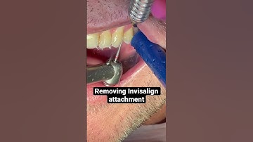 Removing #invisalign attachment #invisalignbeforeandafter #dentist #invisalignjourney