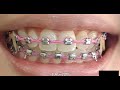 Trending Braces time lapse 2020 - Damon braces for crooked teeth