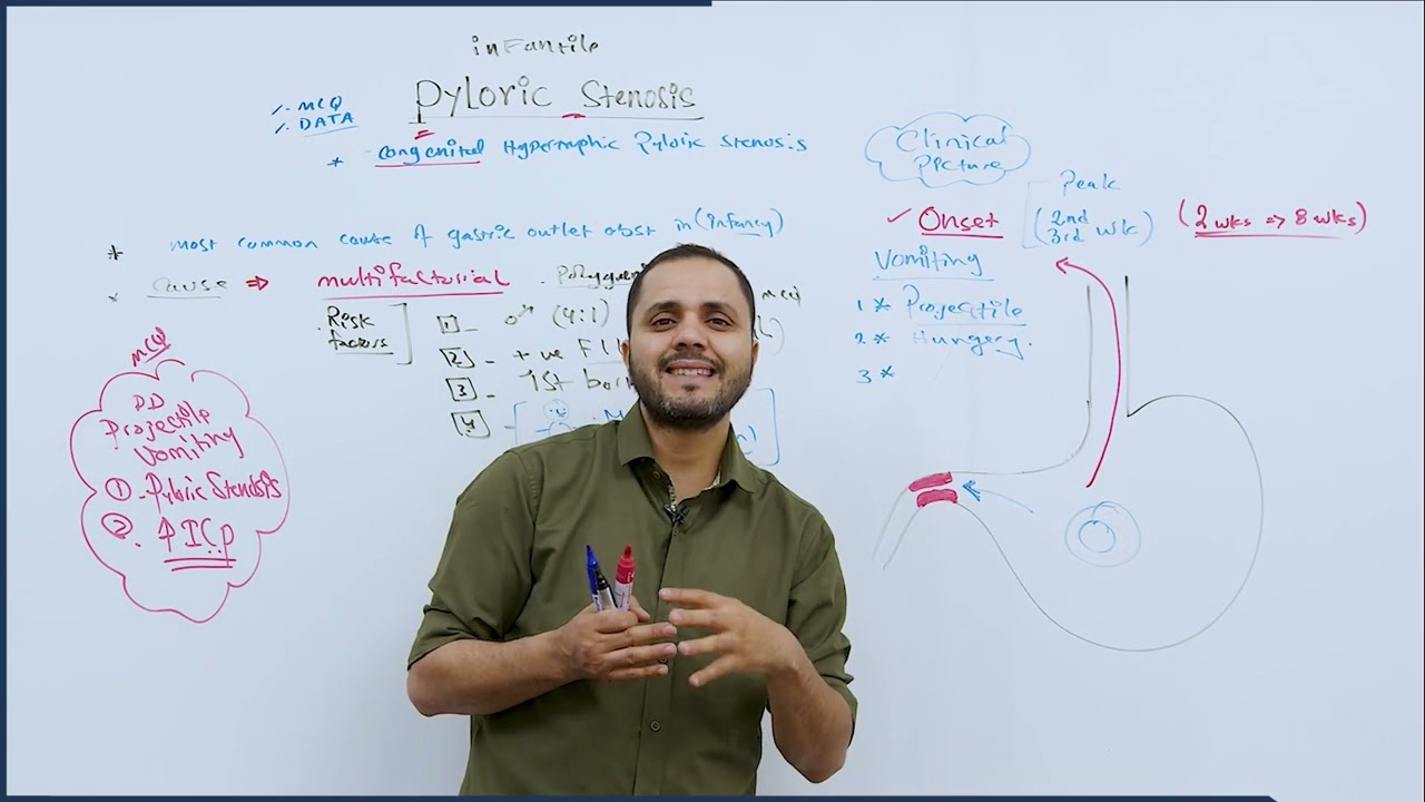 Pyloric Stenosis - د.عبد الرحمن الجعكي
