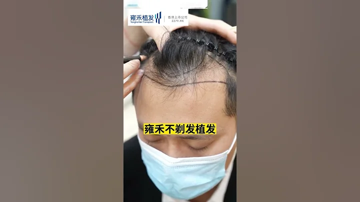 植髮怕疼？植髮怕貴？雍禾不剃髮長髮植髮價格咨詢 - 天天要聞