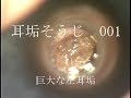 耳垢そうじ/巨大な左耳垢/001
