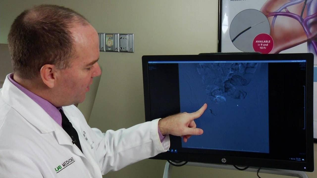 Fibroid Embolization: An Alternative to Hysterectomy?