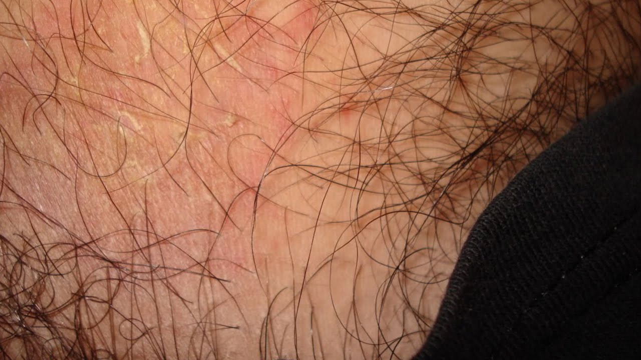 How to Get Rid of jock itch - YouTube