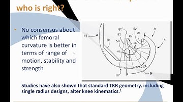 Conformis iTotal Patient Specific Total Knee