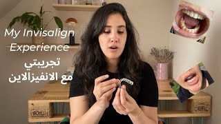 تجريبتي مع انفيزلاين 🦷 My Invisalign experience (part 1)