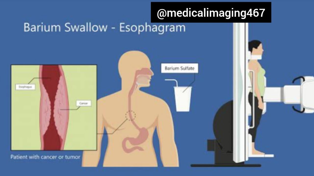 Barium Swallow Fluoroscopy Test YouTube Barium Swallow Fluoroscopy Test YouTube