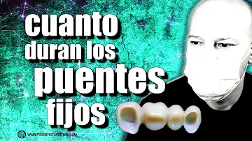 ¿Qué pasa si te sale una caries debajo de un puente?