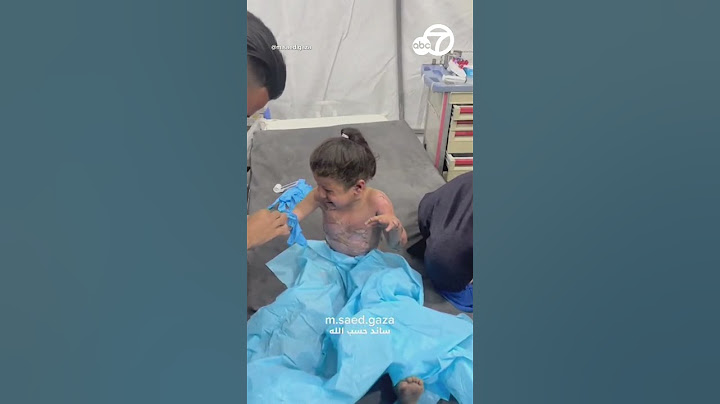 Child in Gaza City treated for burns on arms, chest and chin