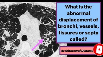 Architectural Distortion in the Chest #radiology #xray #pulmonology