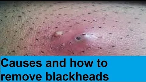  causes and how to remove blackheads