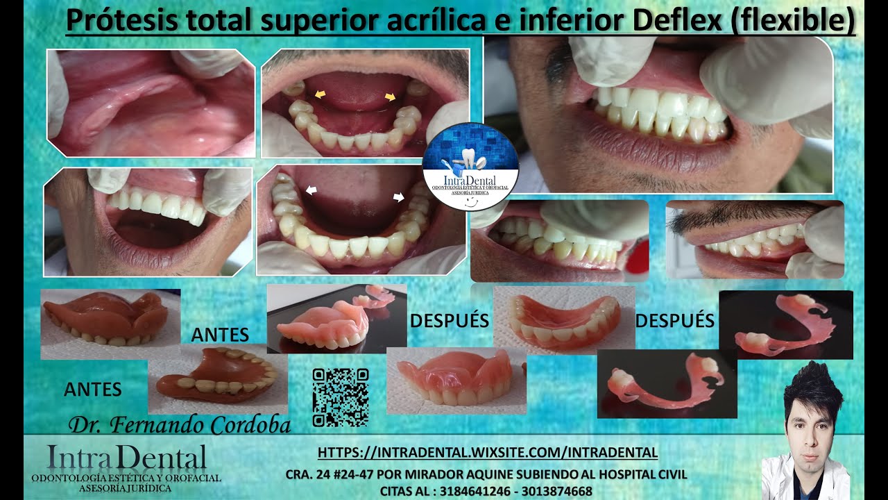 prótesis superior total acrílica y inferior deflex o flexible YouTube