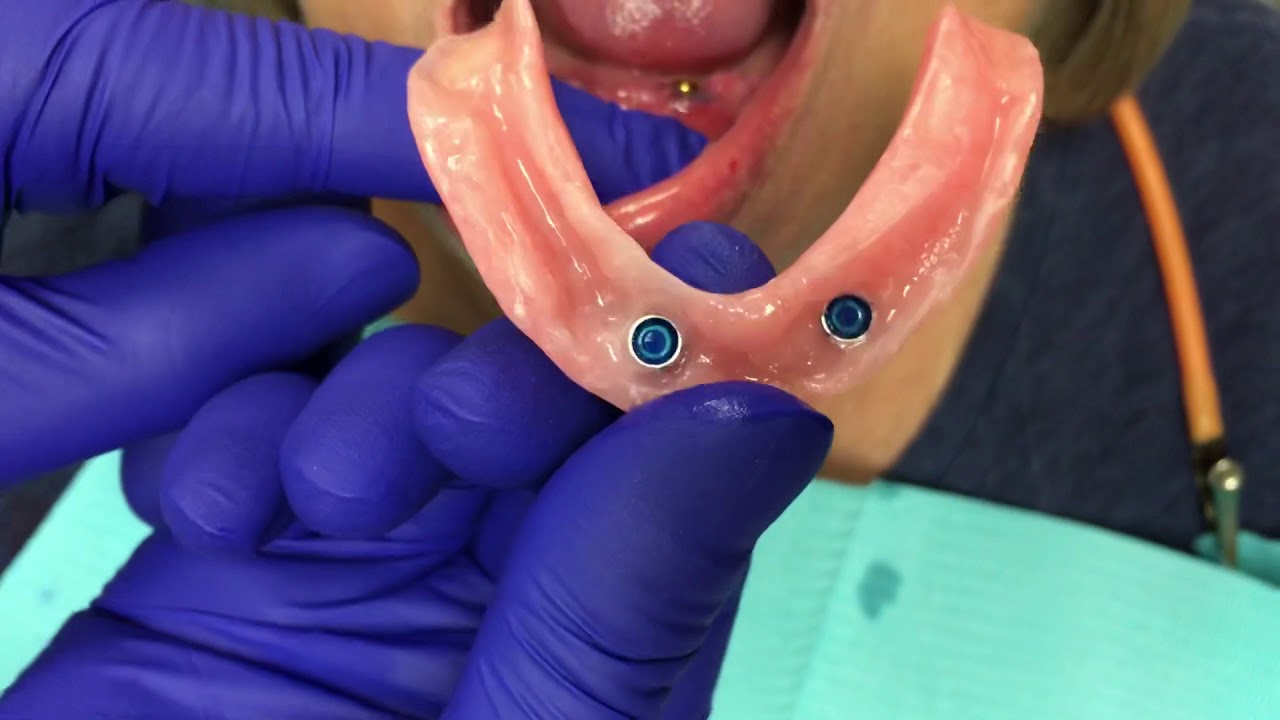 Snap Dentures At Dayton YouTube Snap Dentures At Dayton YouTube