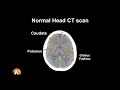 Normal Head CT Scan Anatomy Made Simple- Neuroradiology