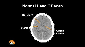 Normal Head CT Scan Anatomy Made Simple- Neuroradiology