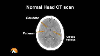 Normální anatomie CT skenování hlavy - Neuroradiologie