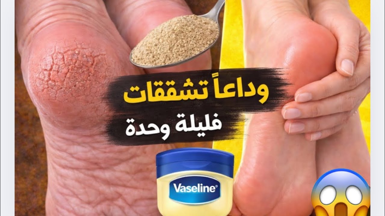 ودعا التشققات القدمين❌هاد الوصفة كترجّعهم ناعمين فليلة وحدة فقط#العناية_بالبشرة#تفتيح_البشرة  