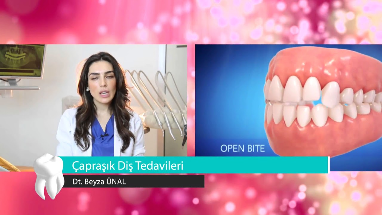 Telsiz çarpık diş tedavisi Telsiz çarpık diş tedavisi