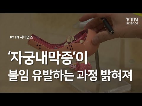 &rsquo;자궁내막증&rsquo;이 불임 유발하는 과정 밝혀져 / YTN 사이언스