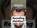 Natural Front Hairline &amp; Temporal Hair Transplant | Immediate Result #shorts #viral #hair #haircare