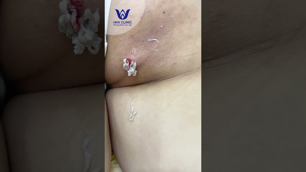 Nặn mụn u nang bã ở H'Mông.