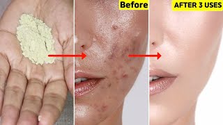 Facewash🙅🏻नहीं मैंने इसे आज़माया-Acne, Bumps, Oily skin, Pigmentation हुए 💯साफ़- चेहरा हुआ निखरा Clean screenshot 4