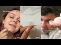 TRYING PIMPLE PATCH TIKTOK COMPILATION